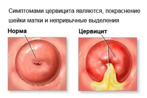хронические цервицит шейки матки