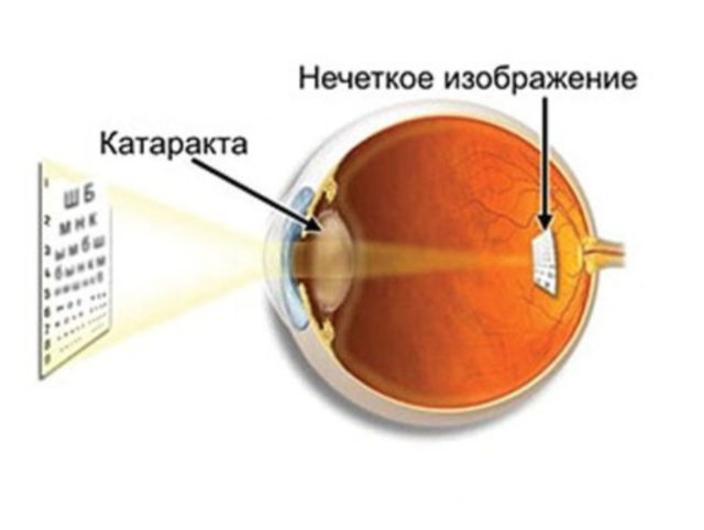 лечение катаракты без операции