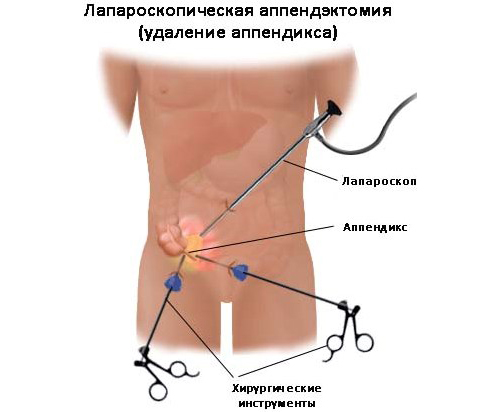 лапароскопия аппендицита