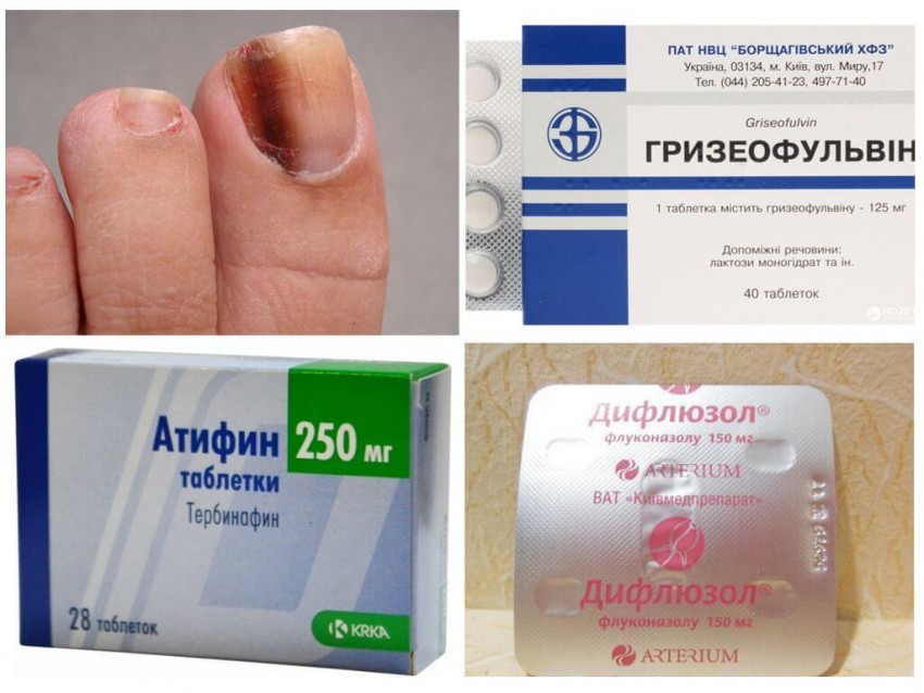 Лечение грибка - советы опытных врачей по подбору эффективных средств избавления от грибка (90 фото)