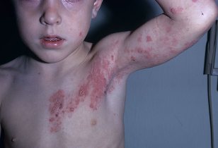 чем лечить лишай у ребенка в домашних условиях
