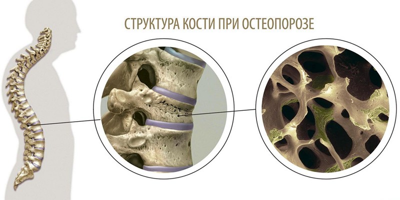 Костная ткань позвоночного столба теряет жесткость остеопороз
