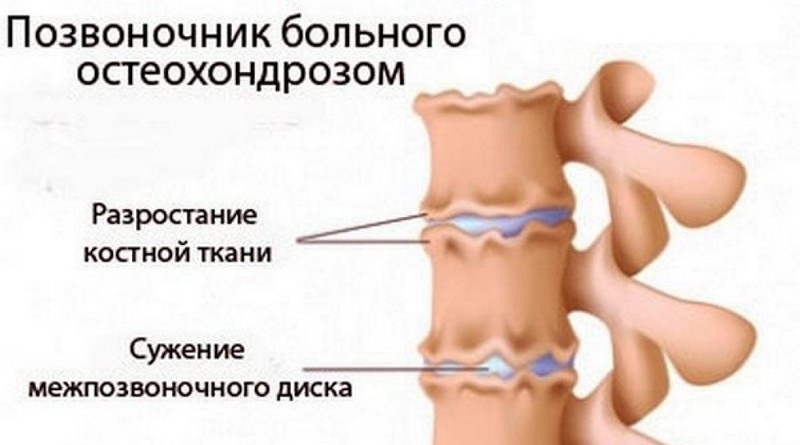 Для профилактики заболевания – активность и спорт Сильная боль между лопатками на позвоночнике