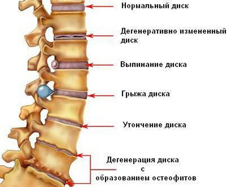 Дегенеративные изменения позвоночника Дегенеративные изменения позвоночника