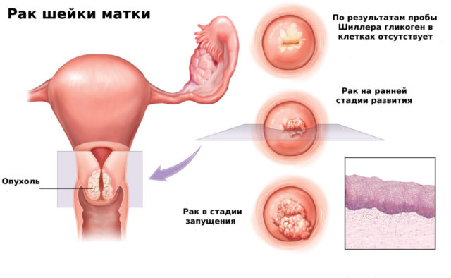 почему появляется рак