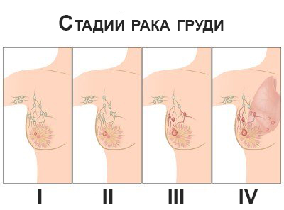 рак молочной железы стадии и выживаемость