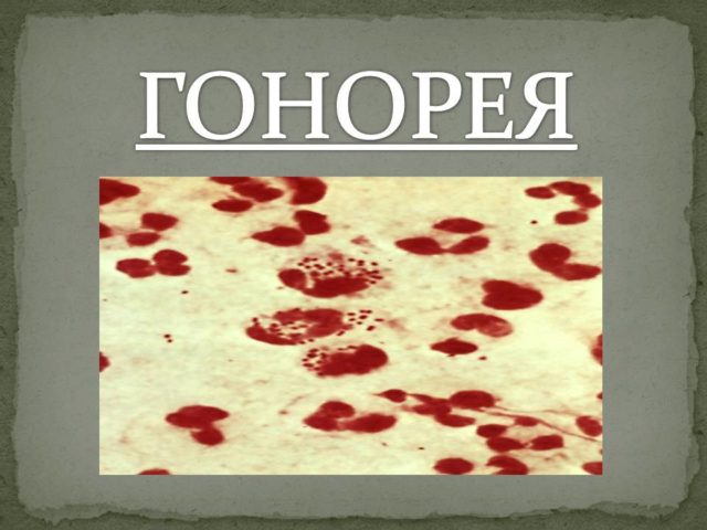 симптомы гонореи