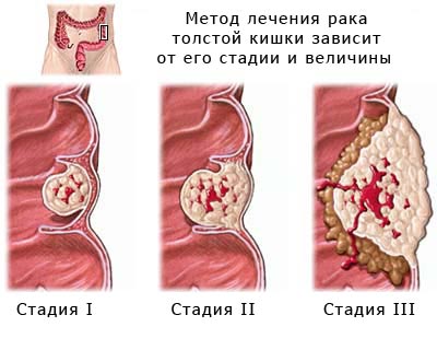 симптомы рака желудка