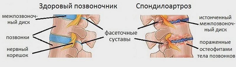 Спондилоартроз позвоночника Спондилоартроз