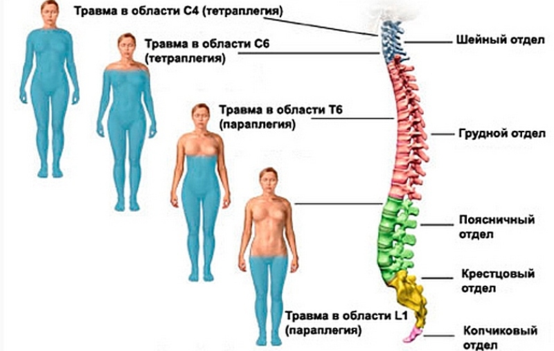 Инфекция может попасть, если произошло какое-либо травматическое воздействие на позвоночник Инфекционное воспаление позвоночника